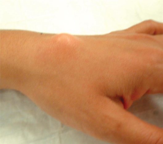 Augšējā plaukstas locītavas gangliona cista (avots: amerikāņu roku ķirurģijas biedrība)