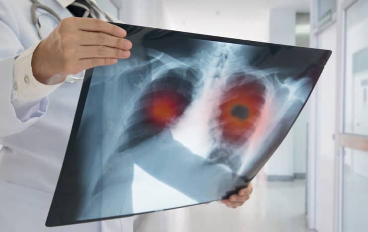 plaušu vēža riska faktori