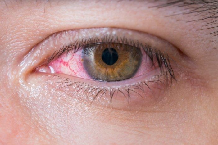 alerģisku sarkano acu konjunktivīts
