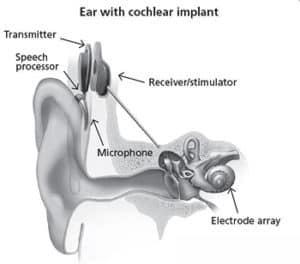 cochlear implantu ierīce