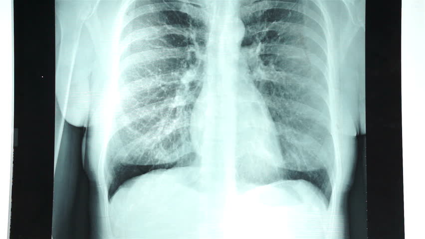 krūšu kurvja rentgena