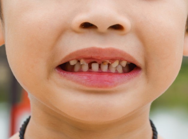 bojājumi bērnu zobiem