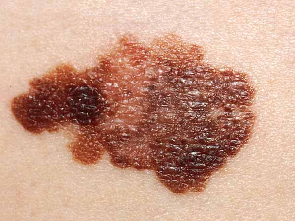 melanomas dzimumzīme